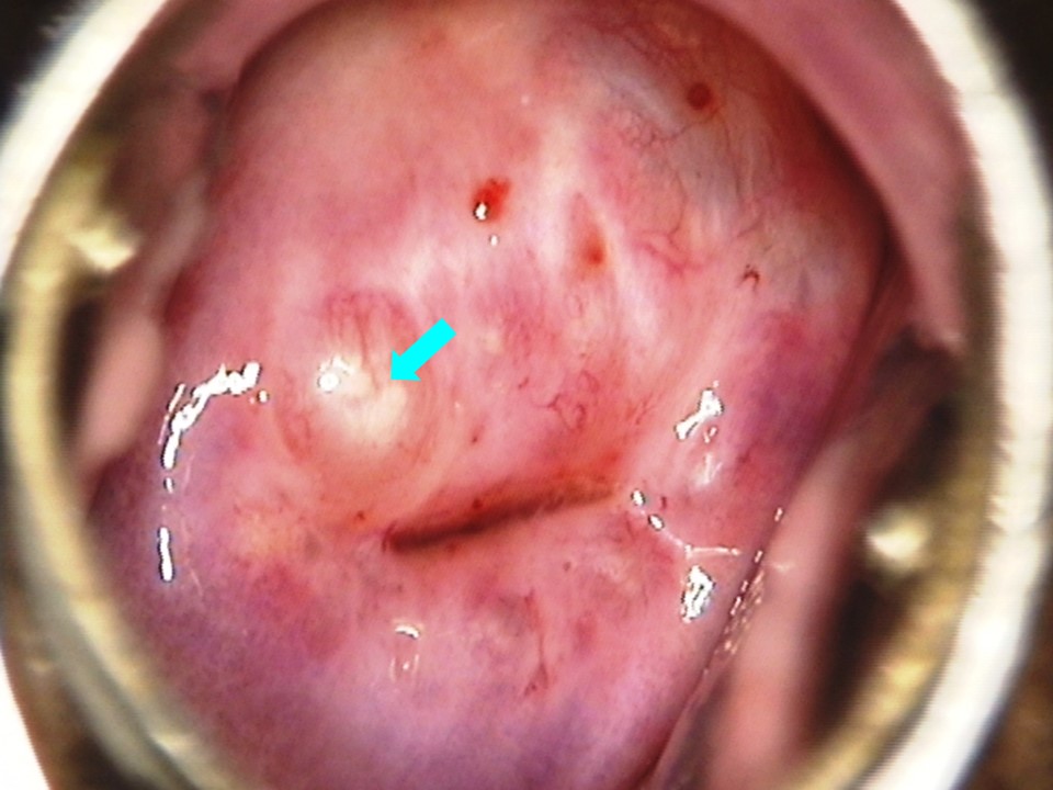 Atlas of visual inspection of the cervix with acetic acid for screening